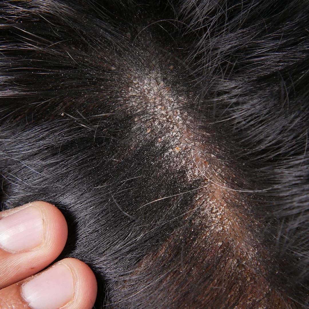 Dermatite Seborreica (Caspa): Guia Completo para o Controle e Tratamento Eficaz